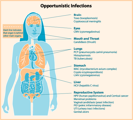 Hiv Opportunistic Infections Chart
